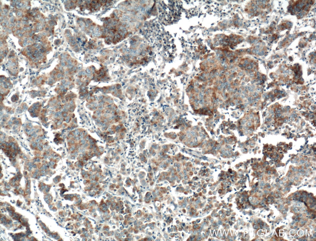 Immunohistochemistry (IHC) staining of human prostate cancer tissue using FGF9 Polyclonal antibody (26554-1-AP)