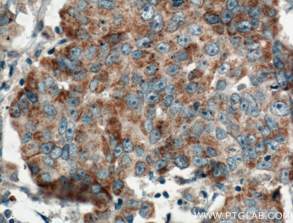 Immunohistochemistry (IHC) staining of human prostate cancer tissue using FGF9 Polyclonal antibody (26554-1-AP)