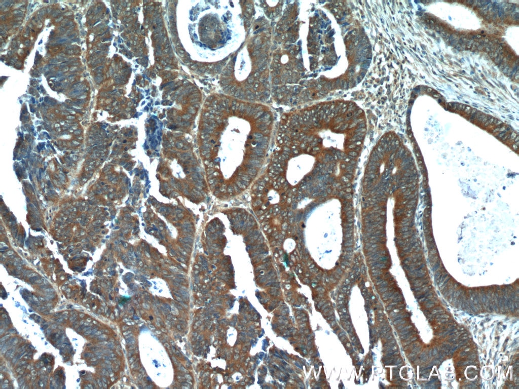 IHC staining of human colon cancer using 25006-1-AP