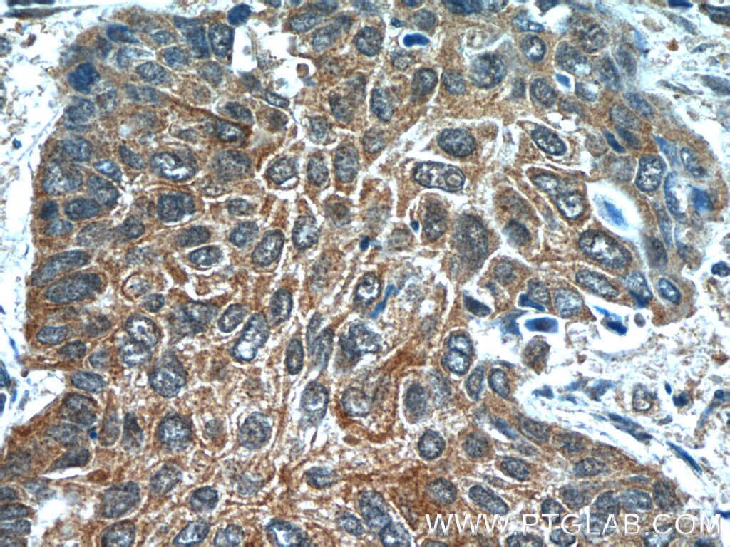 IHC staining of human lung cancer using 25006-1-AP
