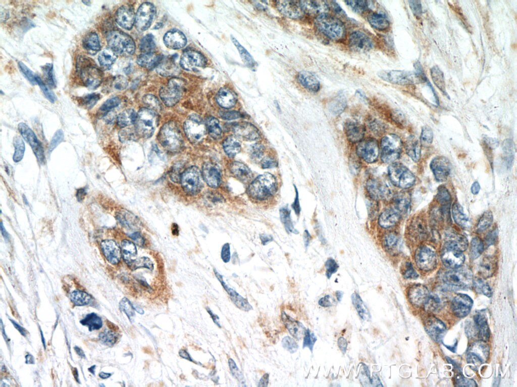 IHC staining of human skin cancer using 25006-1-AP