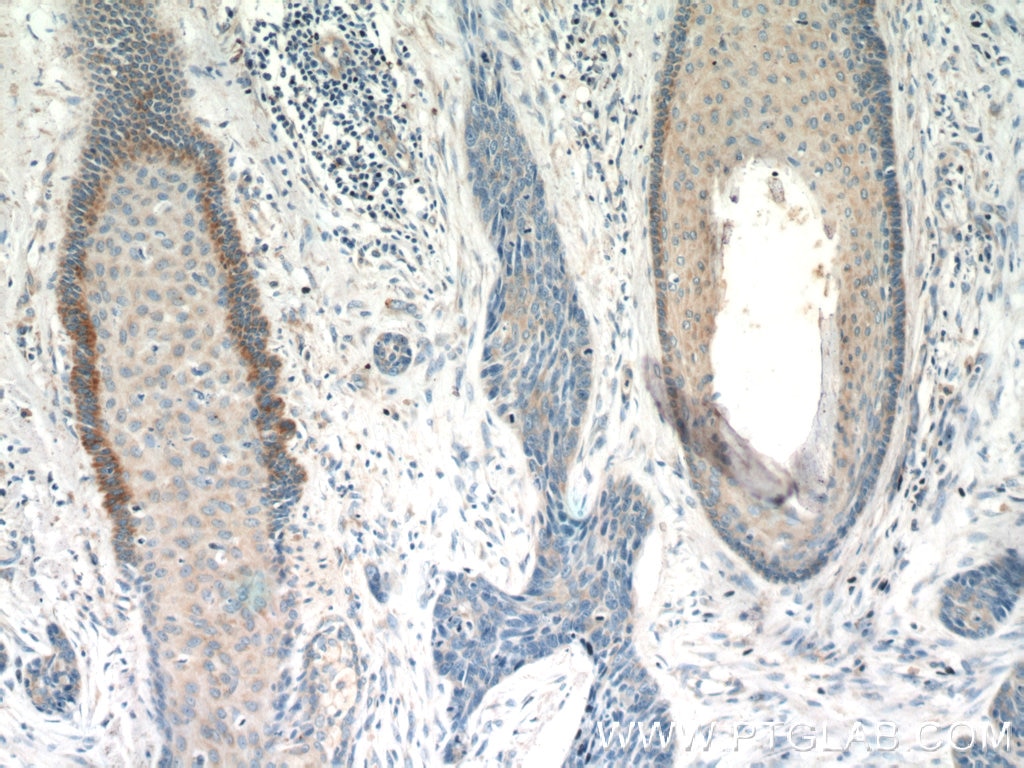 IHC staining of human skin cancer using 25006-1-AP