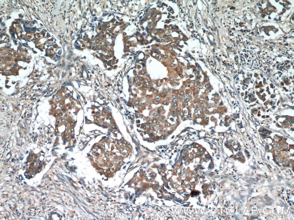 IHC staining of human breast cancer using 25006-1-AP