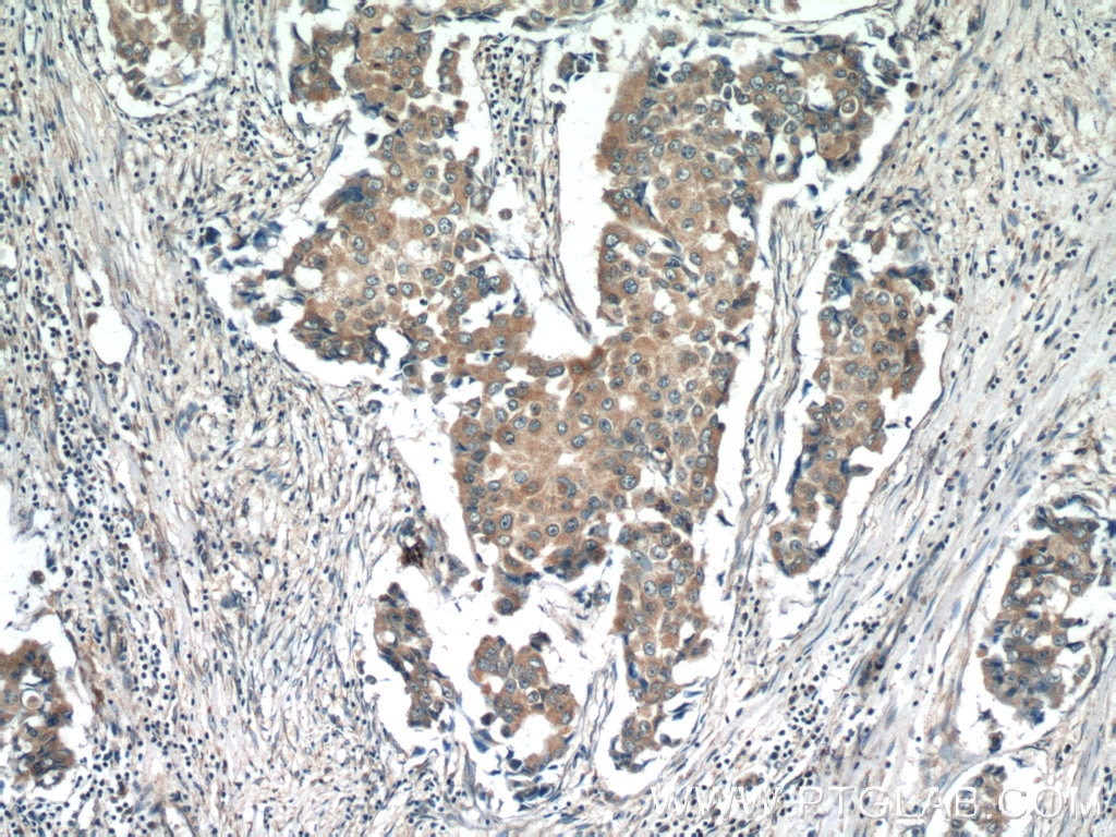 IHC staining of human breast cancer using 25006-1-AP