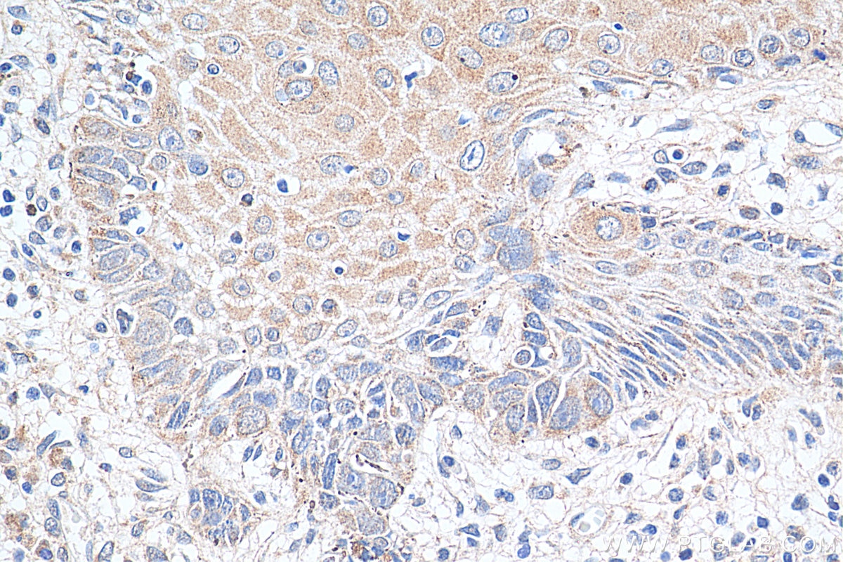 Immunohistochemistry (IHC) staining of human skin cancer tissue using FGFBP1 Polyclonal antibody (25006-1-AP)