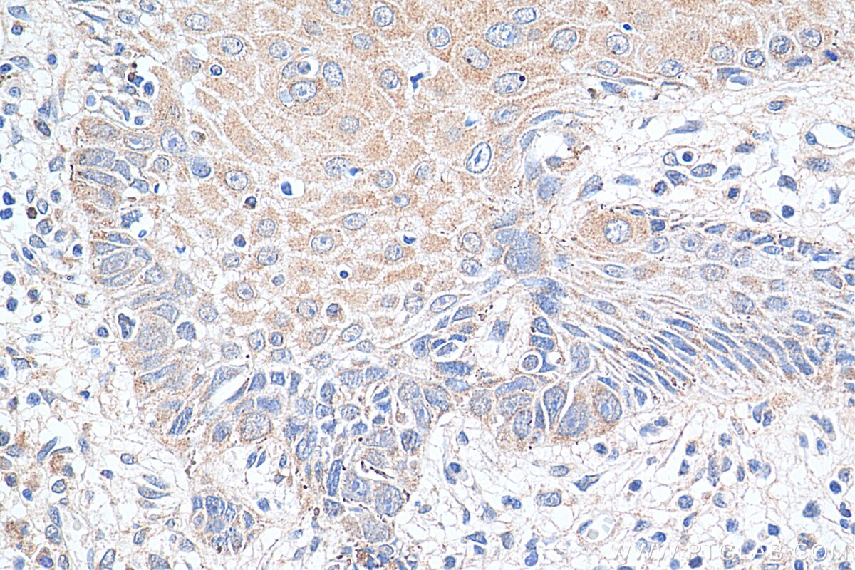 IHC staining of human skin cancer using 25006-1-AP