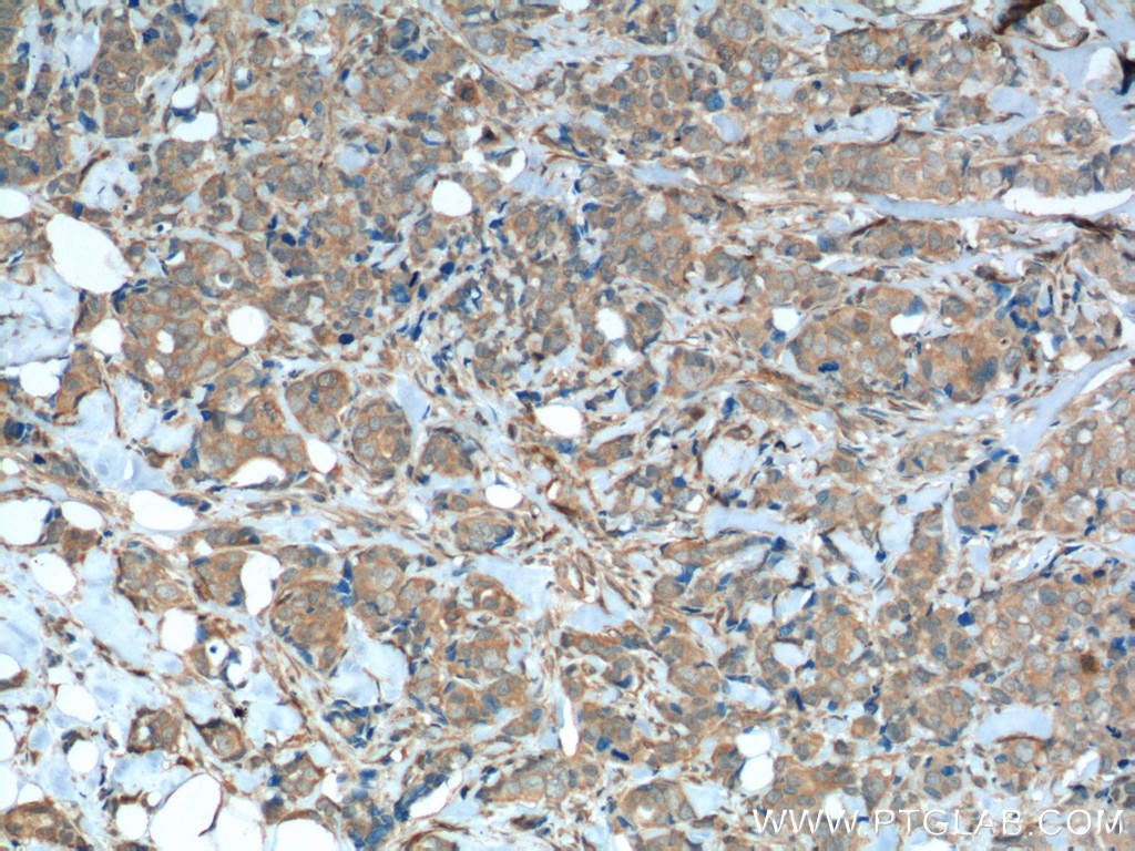 Immunohistochemistry (IHC) staining of human breast cancer tissue using FGFR1 Monoclonal antibody (60325-1-Ig)
