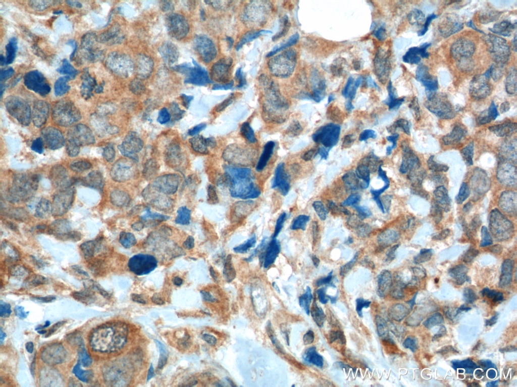 Immunohistochemistry (IHC) staining of human breast cancer tissue using FGFR1 Monoclonal antibody (60325-1-Ig)