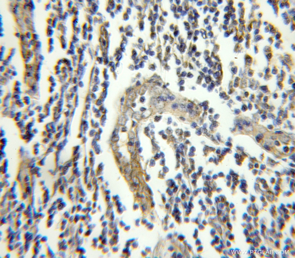 Immunohistochemistry (IHC) staining of human lymphoma tissue using FGFR1OP Polyclonal antibody (11343-1-AP)