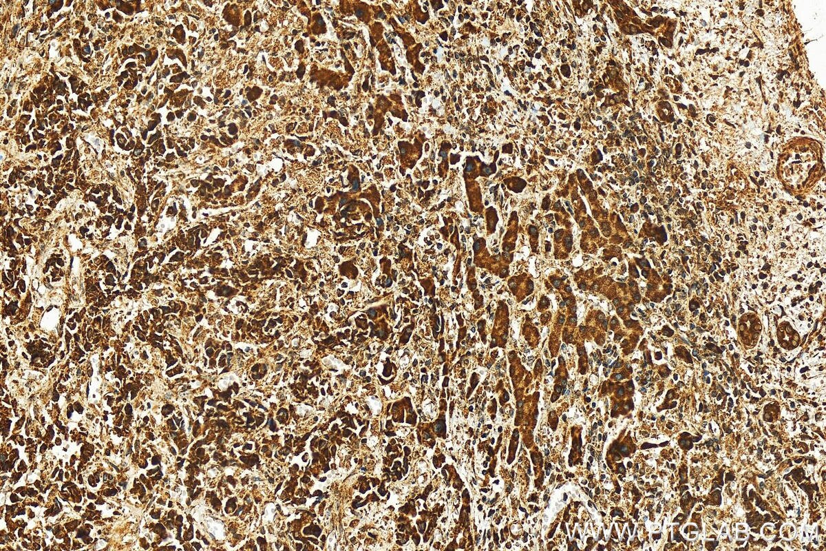 Immunohistochemistry (IHC) staining of human intrahepatic cholangiocarcinoma tissue using FGFR1OP2 Polyclonal antibody (11605-1-AP)