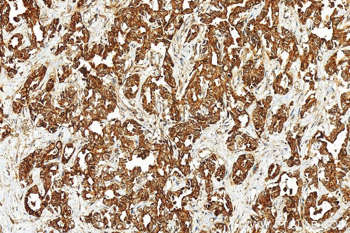 Immunohistochemistry (IHC) staining of human intrahepatic cholangiocarcinoma tissue using FGFR1OP2 Polyclonal antibody (11605-1-AP)