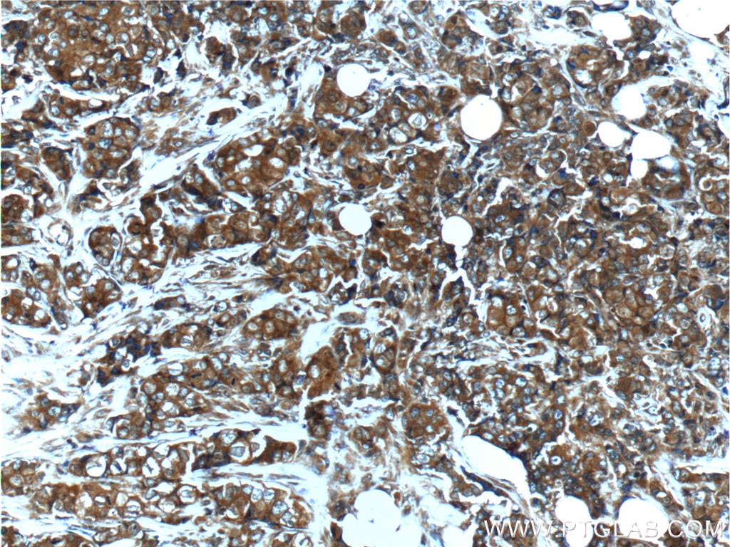IHC staining of human breast cancer using 13042-1-AP