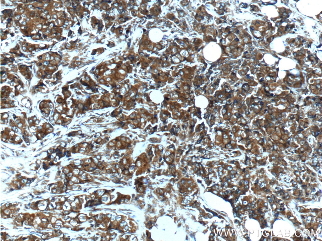 Immunohistochemistry (IHC) staining of human breast cancer tissue using FGFR2 Polyclonal antibody (13042-1-AP)