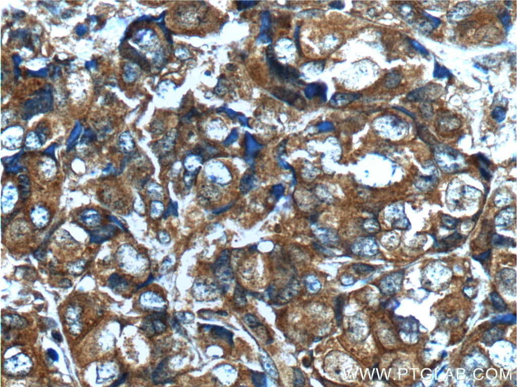 Immunohistochemistry (IHC) staining of human breast cancer tissue using FGFR2 Polyclonal antibody (13042-1-AP)