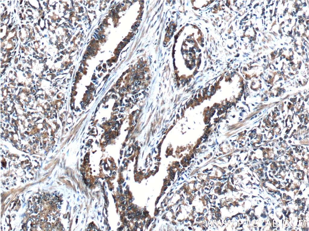 Immunohistochemistry (IHC) staining of human prostate cancer tissue using FGFR2 Polyclonal antibody (13042-1-AP)