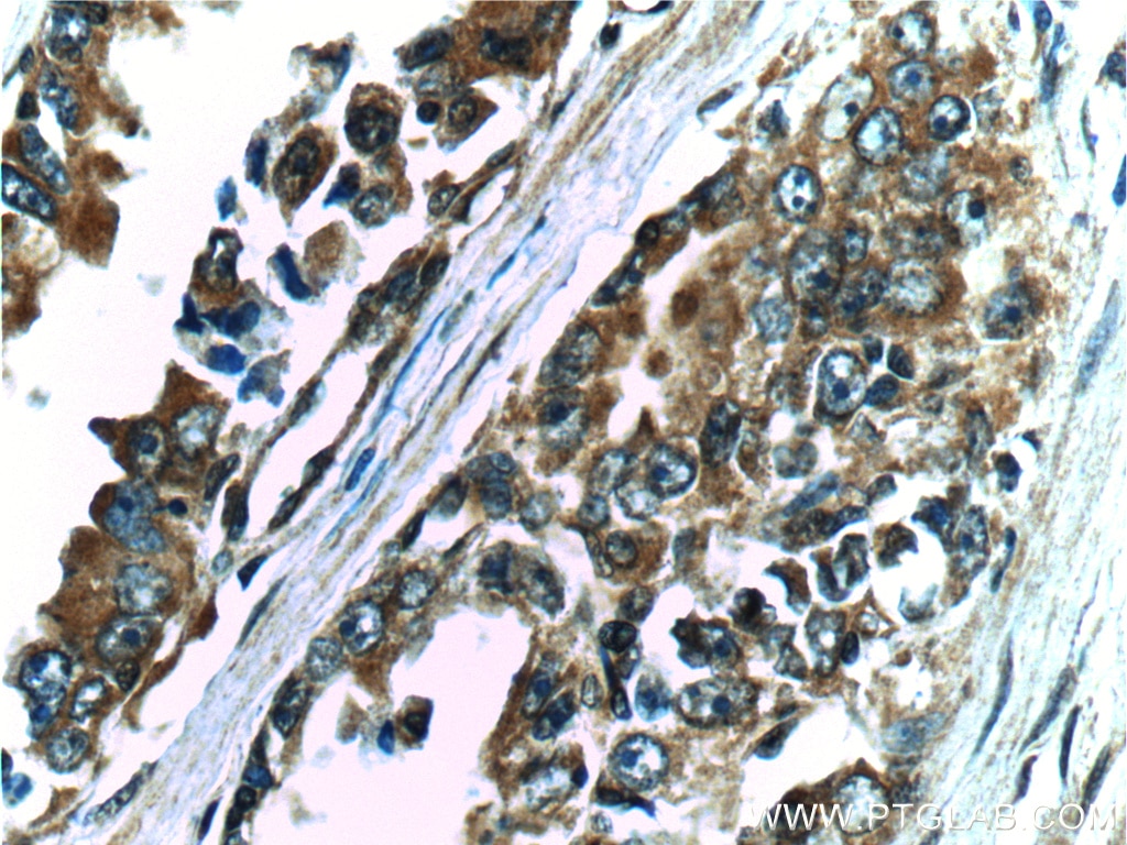Immunohistochemistry (IHC) staining of human prostate cancer tissue using FGFR2 Polyclonal antibody (13042-1-AP)