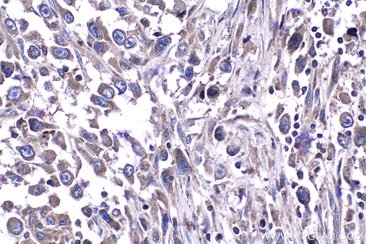 Immunohistochemistry (IHC) staining of human lung cancer tissue using FGFR3 Polyclonal antibody (55358-1-AP)