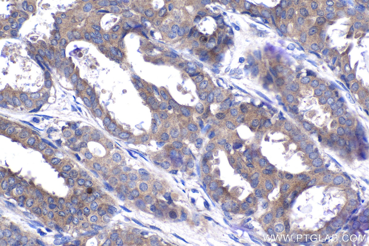 Immunohistochemistry (IHC) staining of human breast cancer tissue using FGFR3 Polyclonal antibody (55358-1-AP)