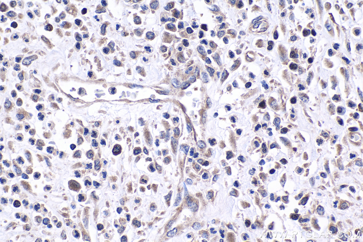 Immunohistochemistry (IHC) staining of human colon cancer tissue using FGFR3 Polyclonal antibody (55358-1-AP)