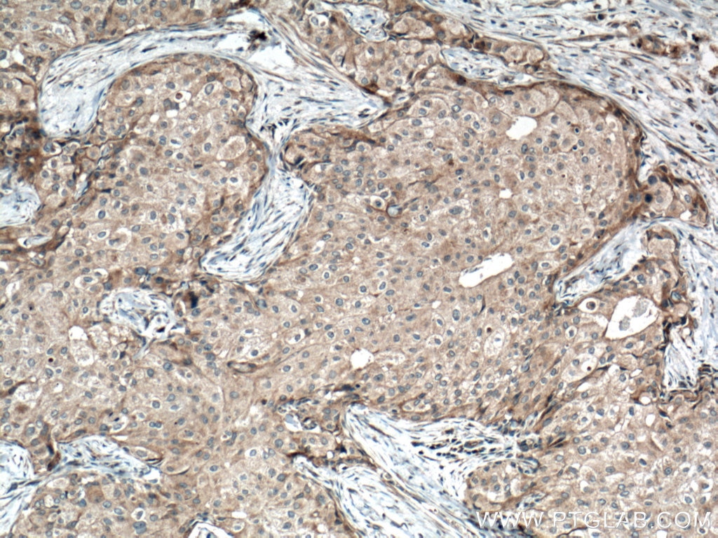 Immunohistochemistry (IHC) staining of human breast cancer tissue using FGFR4 Polyclonal antibody (11098-1-AP)