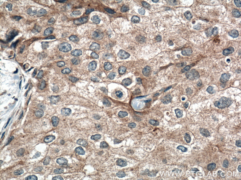 Immunohistochemistry (IHC) staining of human breast cancer tissue using FGFR4 Polyclonal antibody (11098-1-AP)
