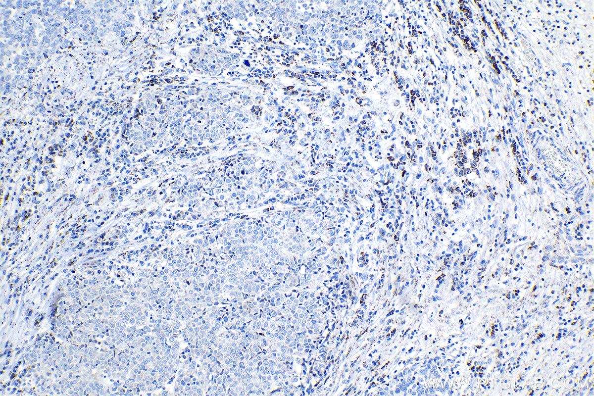 IHC staining of human ovary tumor using 81069-1-RR Immunohistochemistry (IHC) staining of human ovary tumor tissue using FGFR4 Recombinant monoclonal antibody (81069-1-RR)