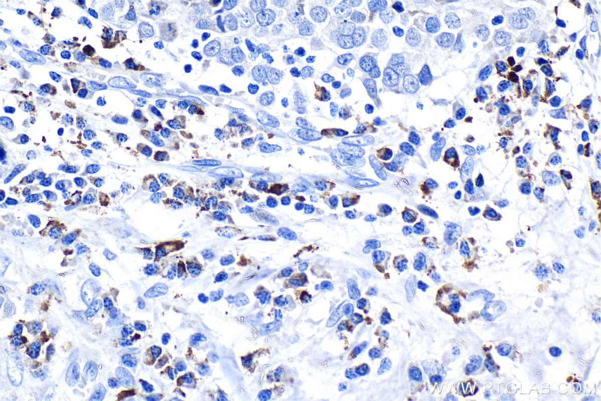 IHC staining of human ovary tumor using 81069-1-RR Immunohistochemistry (IHC) staining of human ovary tumor tissue using FGFR4 Recombinant monoclonal antibody (81069-1-RR)