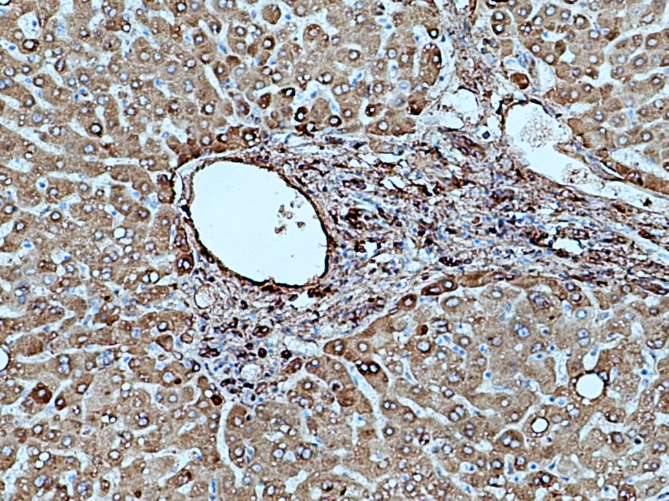 Immunohistochemistry (IHC) staining of human hepatocirrhosis tissue using Fibrinogen Gamma Chain Polyclonal antibody (15841-1-AP)