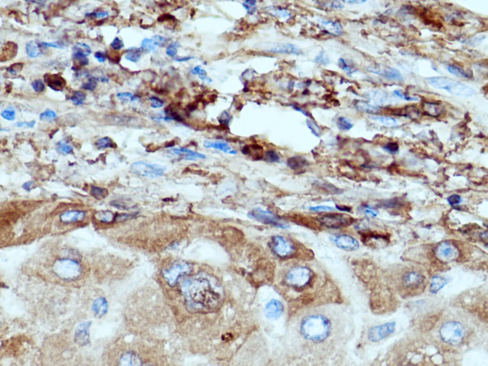 Immunohistochemistry (IHC) staining of human hepatocirrhosis tissue using Fibrinogen Gamma Chain Polyclonal antibody (15841-1-AP)