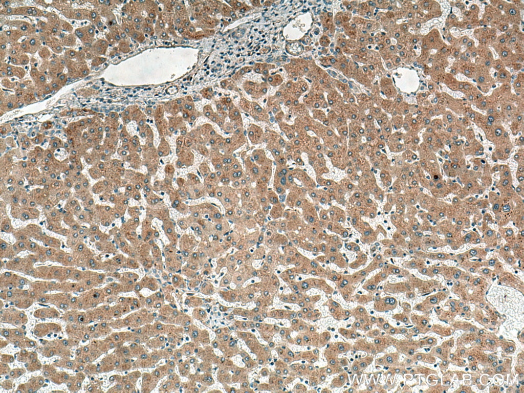 IHC staining of human hepatocirrhosis using 16000-1-AP