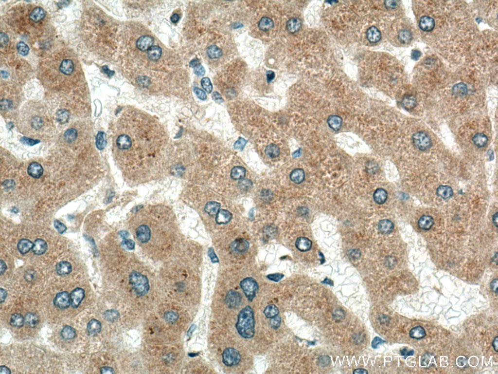 Immunohistochemistry (IHC) staining of human hepatocirrhosis tissue using FGL1 Polyclonal antibody (16000-1-AP)