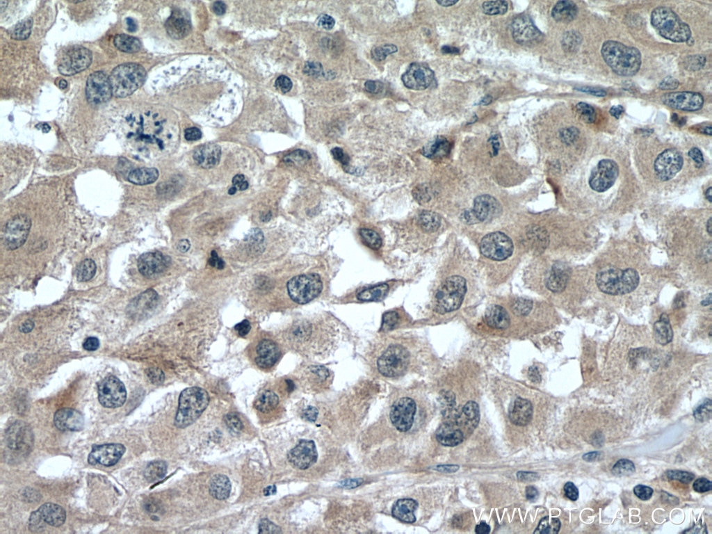 Immunohistochemistry (IHC) staining of human liver cancer tissue using FGL1 Polyclonal antibody (16000-1-AP)