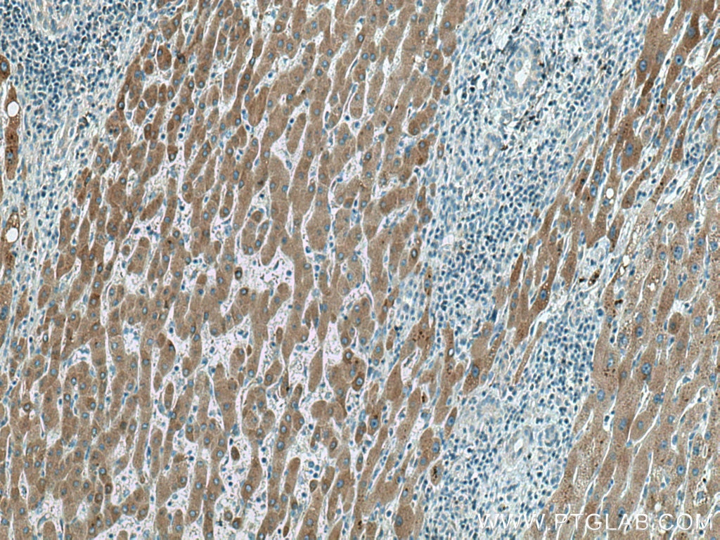 Immunohistochemistry (IHC) staining of human liver cancer tissue using FGL1 Monoclonal antibody (67391-1-Ig)