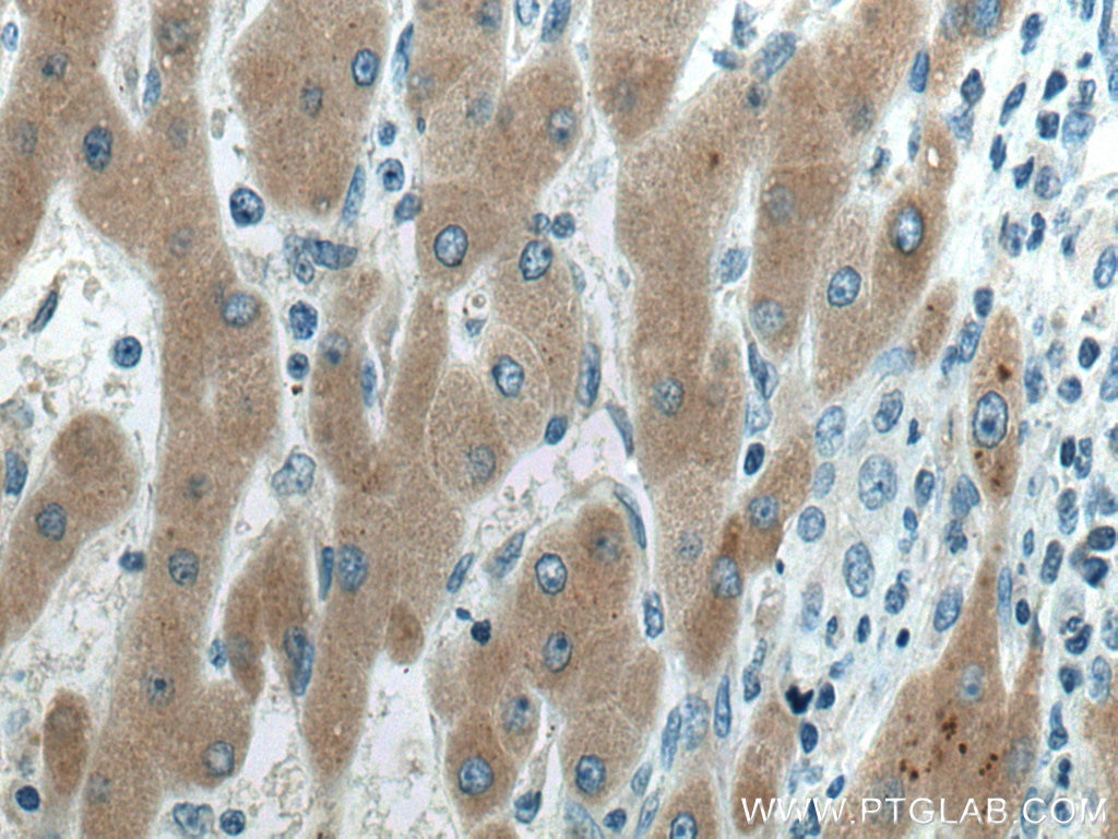 Immunohistochemistry (IHC) staining of human liver cancer tissue using FGL1 Monoclonal antibody (67391-1-Ig)