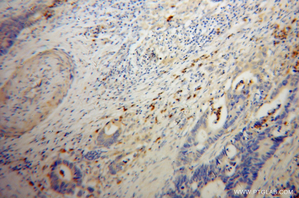 Immunohistochemistry (IHC) staining of human colon cancer tissue using FGL2 Polyclonal antibody (11827-1-AP)