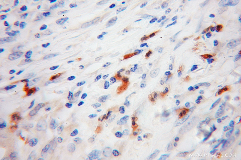 Immunohistochemistry (IHC) staining of human colon cancer tissue using FGL2 Polyclonal antibody (11827-1-AP)