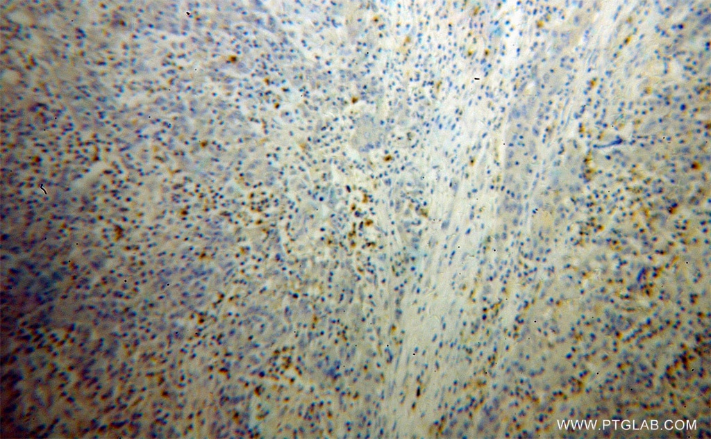 Immunohistochemistry (IHC) staining of human colon cancer tissue using FGL2 Polyclonal antibody (11827-1-AP)