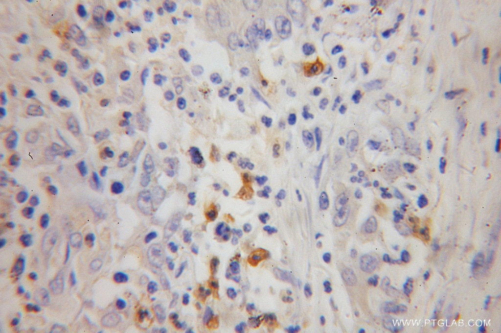 Immunohistochemistry (IHC) staining of human colon cancer tissue using FGL2 Polyclonal antibody (11827-1-AP)