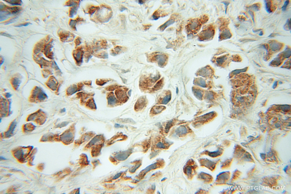 Immunohistochemistry (IHC) staining of human prostate cancer tissue using FH Polyclonal antibody (10966-1-AP)