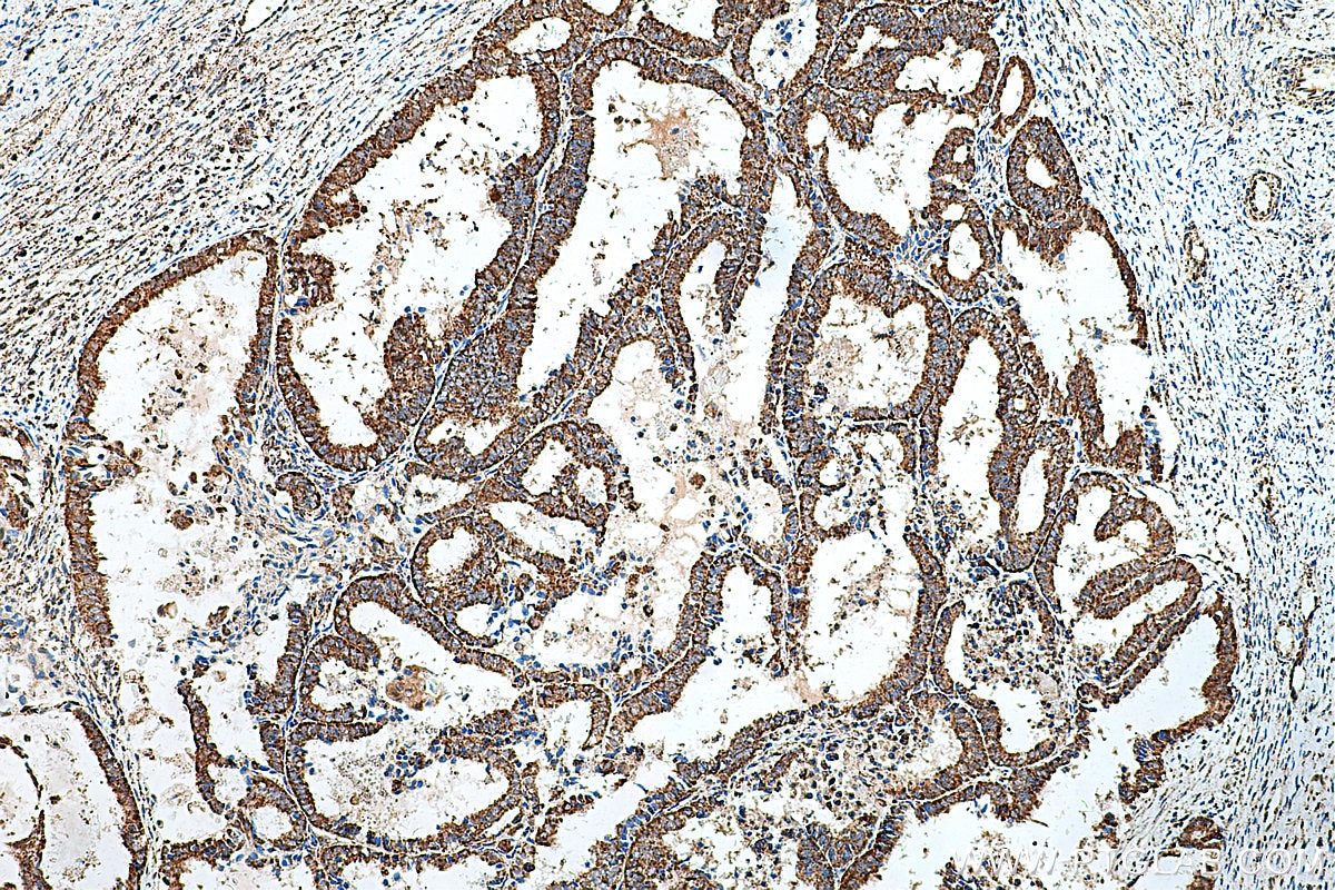 Immunohistochemistry (IHC) staining of human ovary tumor tissue using FH Polyclonal antibody (11375-1-AP)