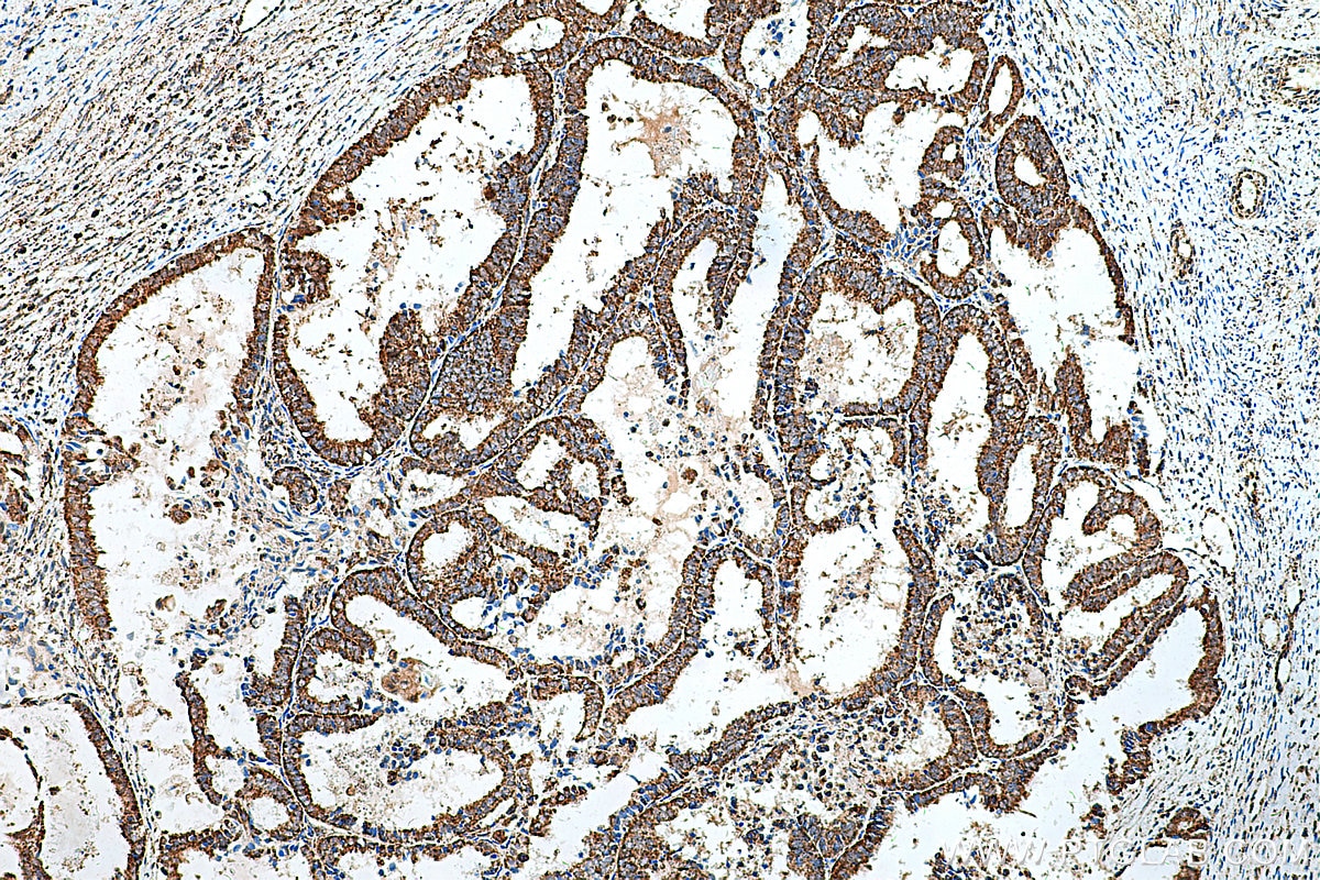 IHC staining of human ovary tumor using 11375-1-AP