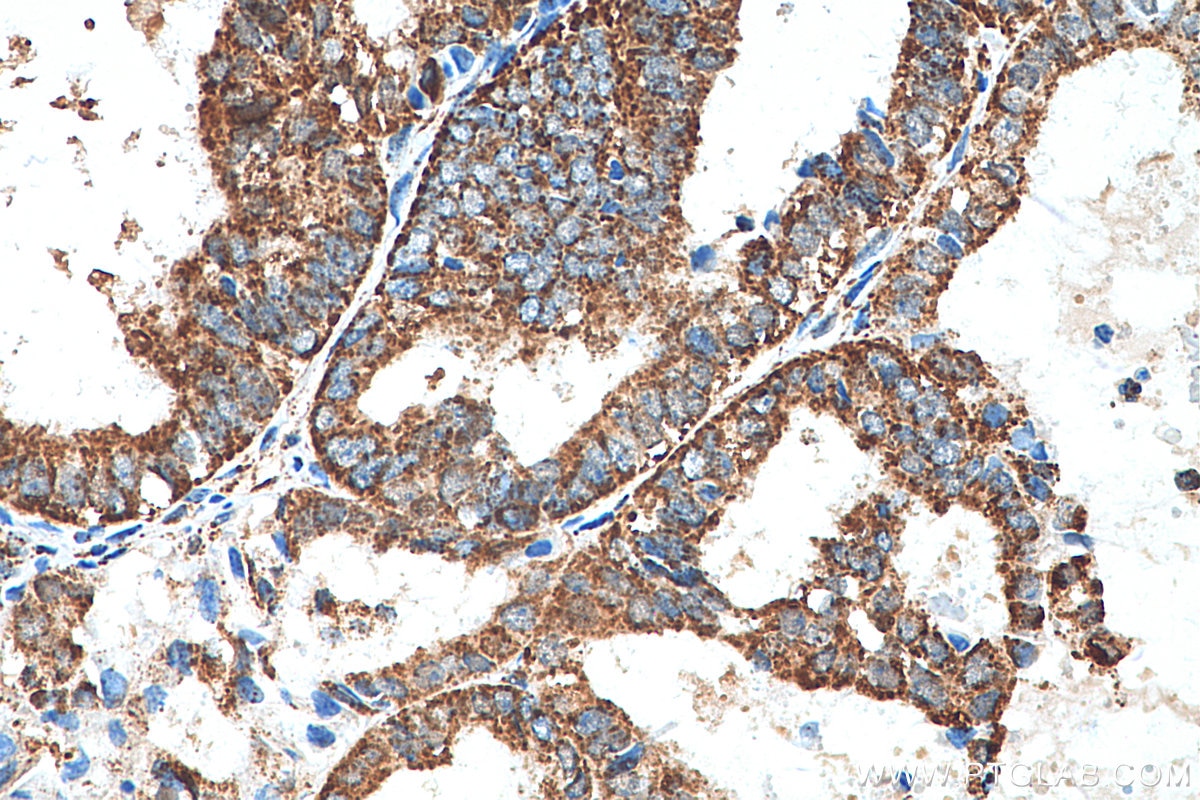 Immunohistochemistry (IHC) staining of human ovary tumor tissue using FH Polyclonal antibody (11375-1-AP)