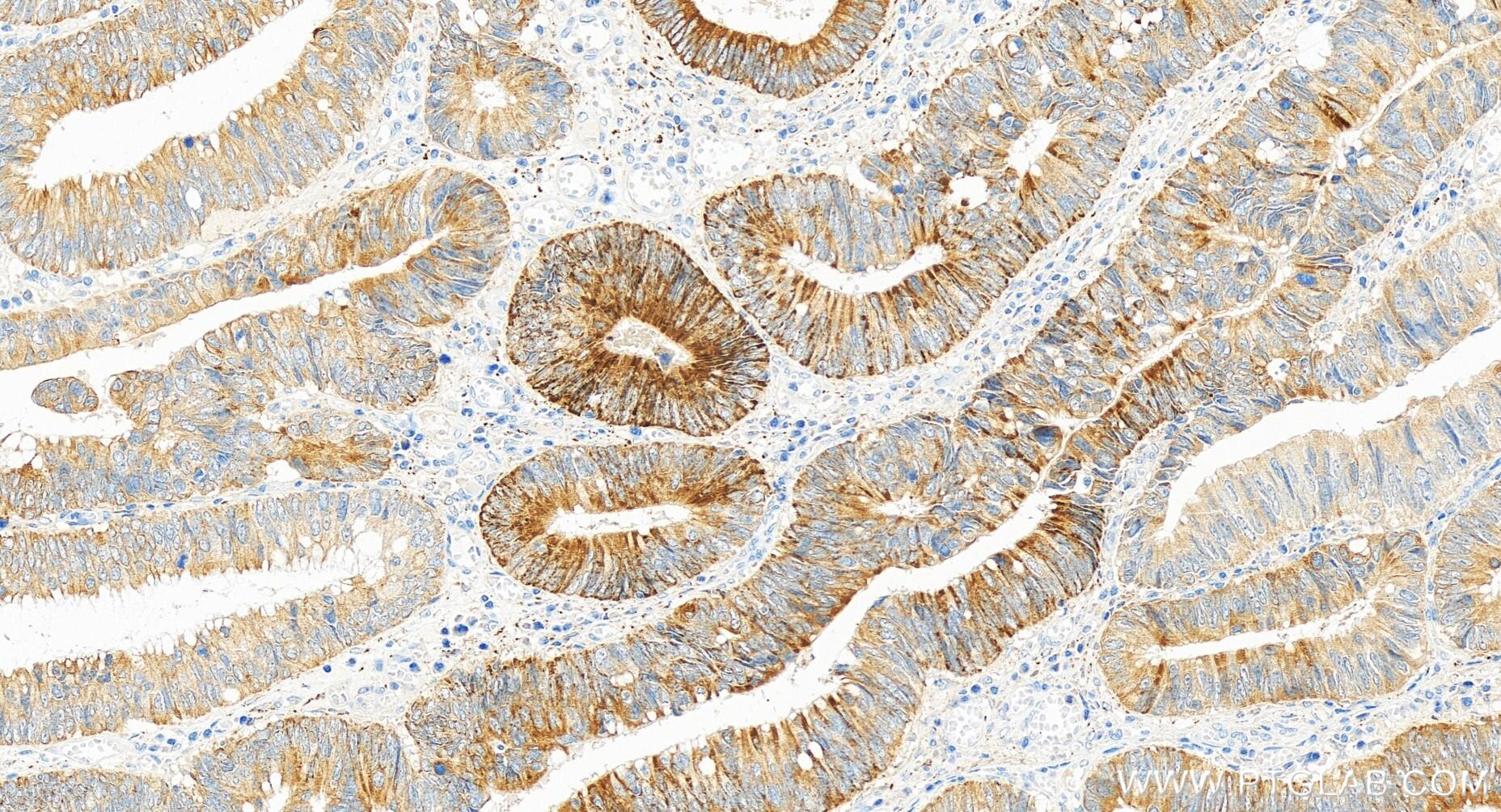 Immunohistochemistry (IHC) staining of human colon cancer tissue using FHIT Recombinant antibody (83710-1-RR)