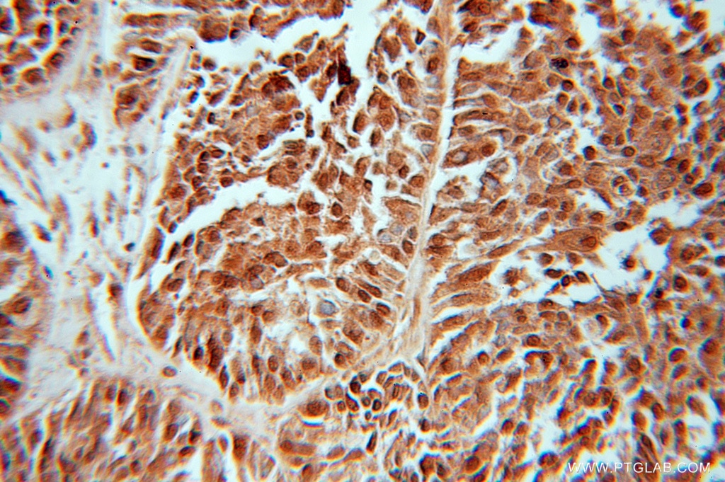 Immunohistochemistry (IHC) staining of human ovary tumor tissue using FHL1 Polyclonal antibody (10991-1-AP)