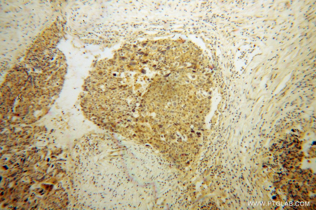Immunohistochemistry (IHC) staining of human ovary tumor tissue using FHL3 Polyclonal antibody (11028-2-AP)