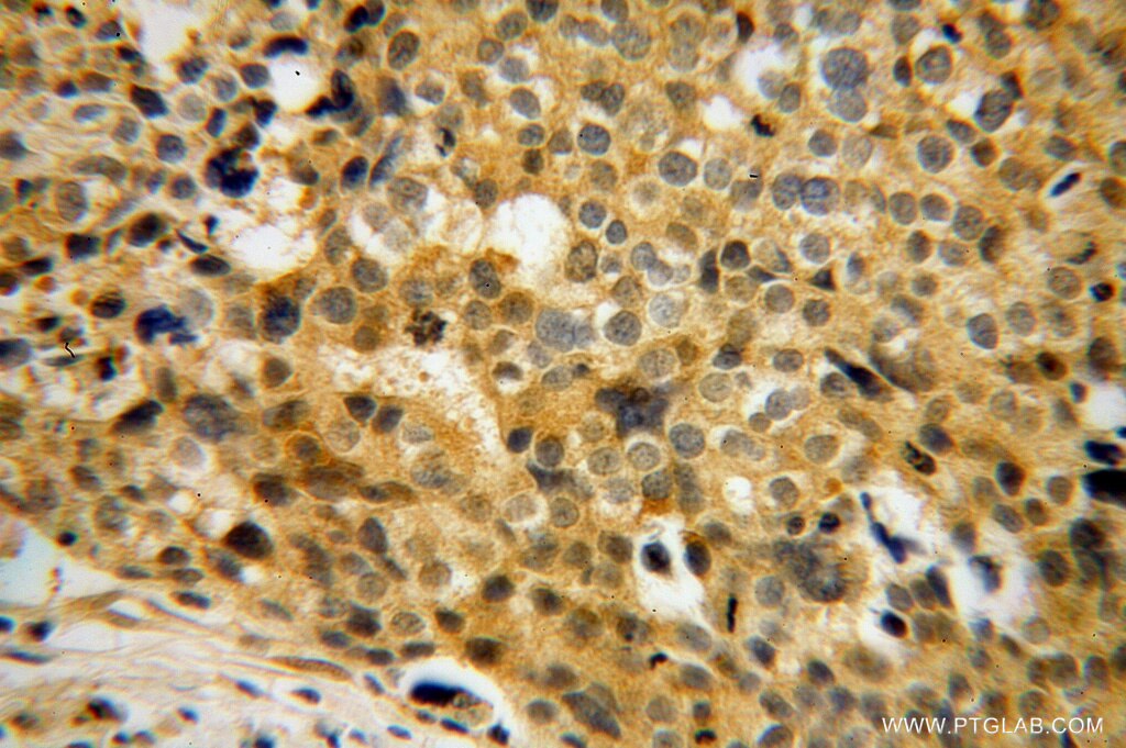 Immunohistochemistry (IHC) staining of human ovary tumor tissue using FHL3 Polyclonal antibody (11028-2-AP)