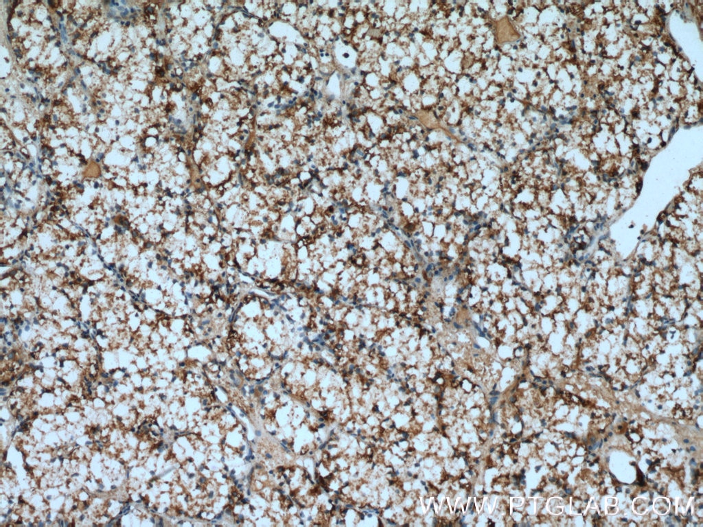 Immunohistochemistry (IHC) staining of human renal cell carcinoma tissue using FIG4 Polyclonal antibody (13875-1-AP)