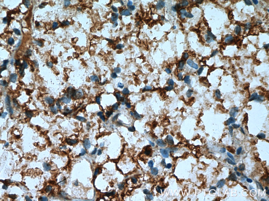 Immunohistochemistry (IHC) staining of human renal cell carcinoma tissue using FIG4 Polyclonal antibody (13875-1-AP)
