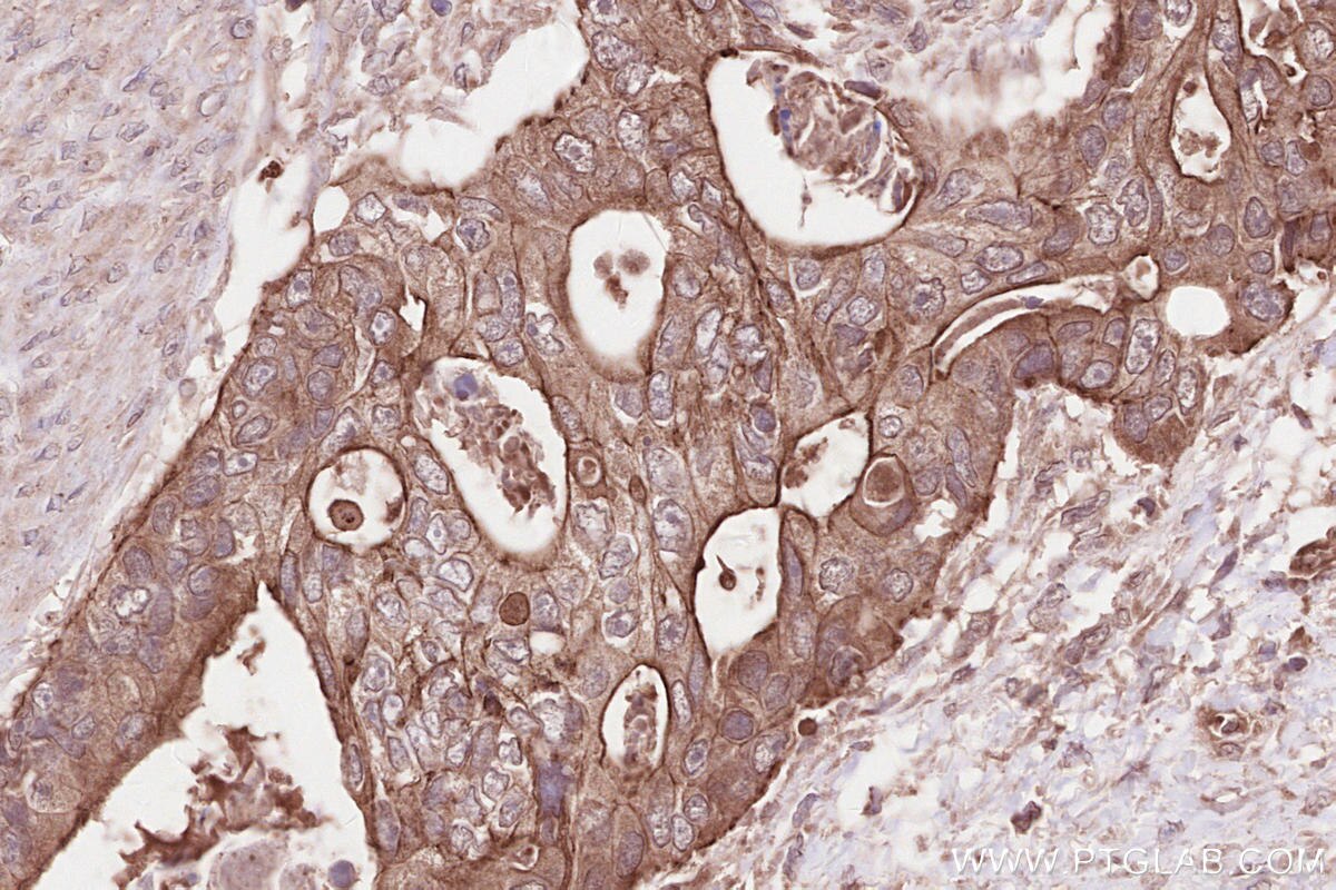IHC staining of human stomach cancer using 17604-1-AP Immunohistochemistry (IHC) staining of human stomach cancer tissue using FIGNL1 Polyclonal antibody (17604-1-AP)