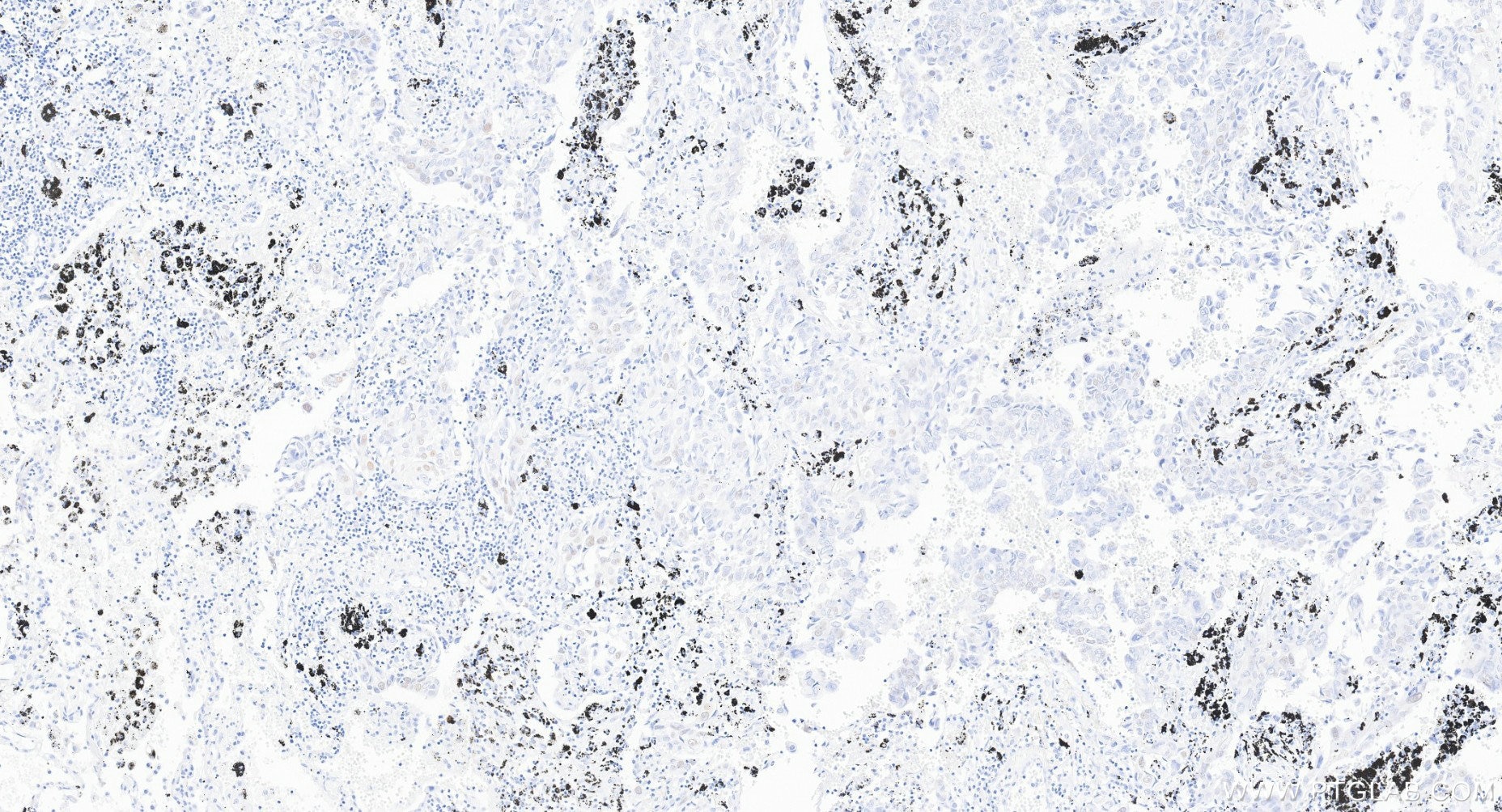 IHC staining of Human lung cancer (Adenocarcinoma) using 86971-1-RR (same clone as 86971-1-PBS) Immunohistochemistry (IHC) staining of Human lung cancer (Adenocarcinoma) using FIGNL1 Recombinant monoclonal antibody (86971-1-RR)